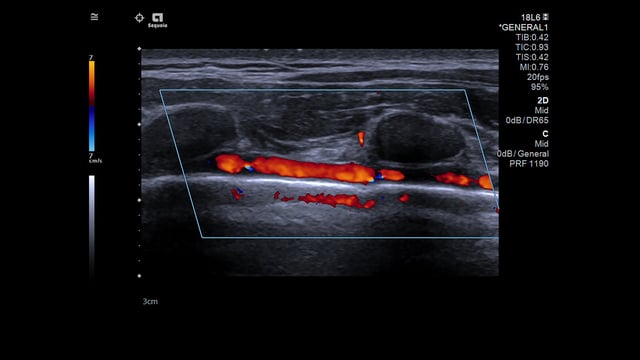 Ultrasound in the Age of COVID-19