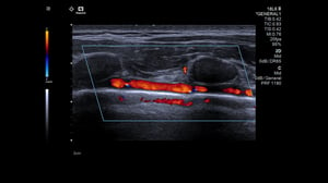 Lung Ultrasound with Color Doppler