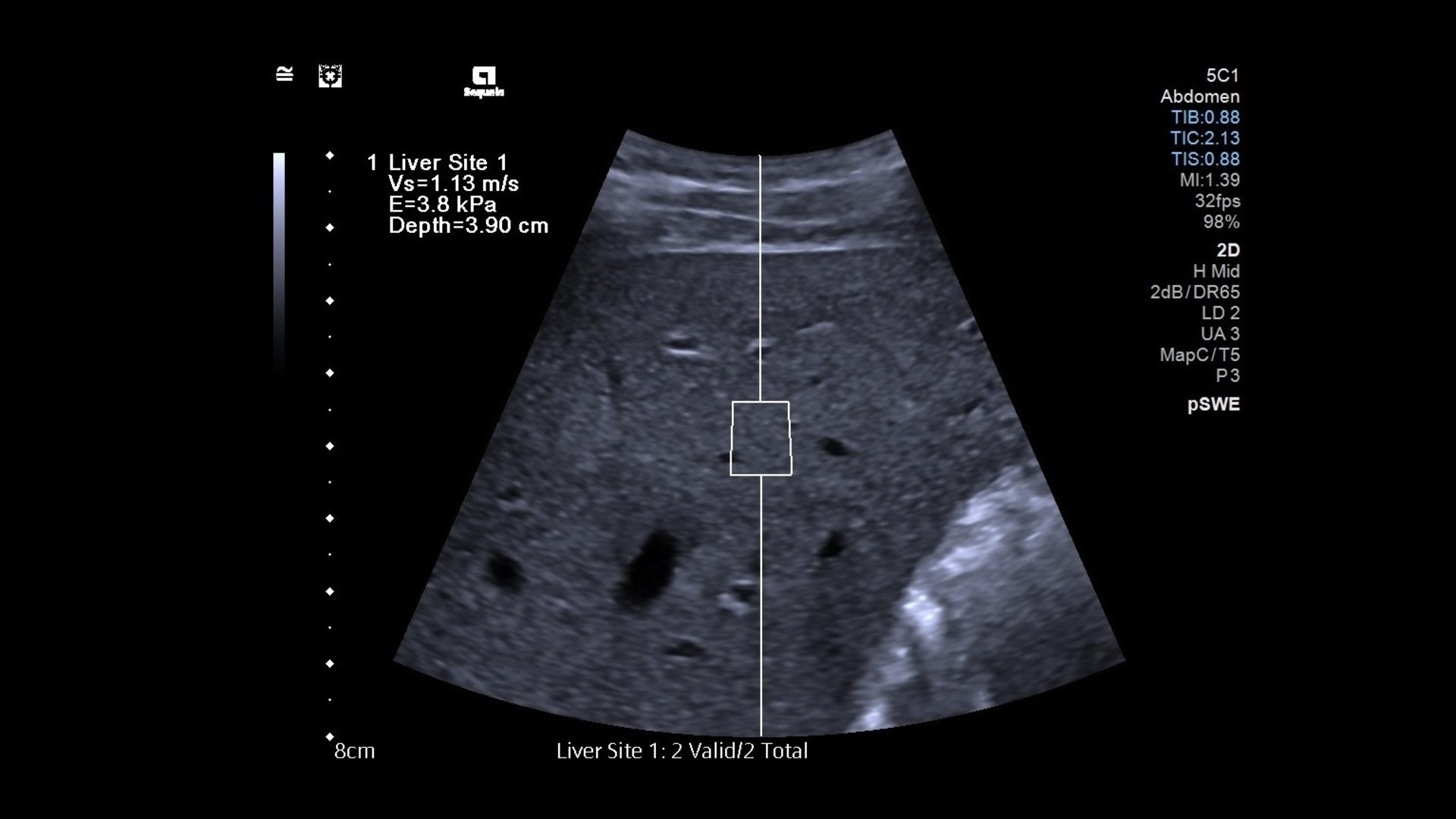 Shear wave elastography