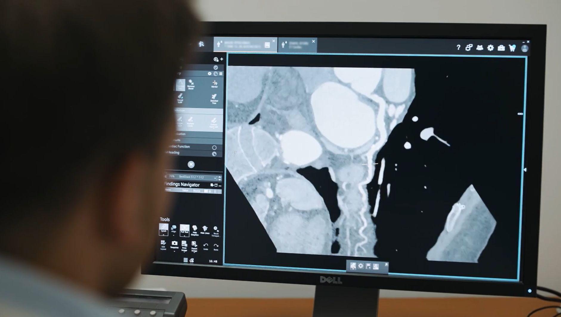 Siemens-Healthineers-press-SyngoCT-Coronary-Cockpit_3