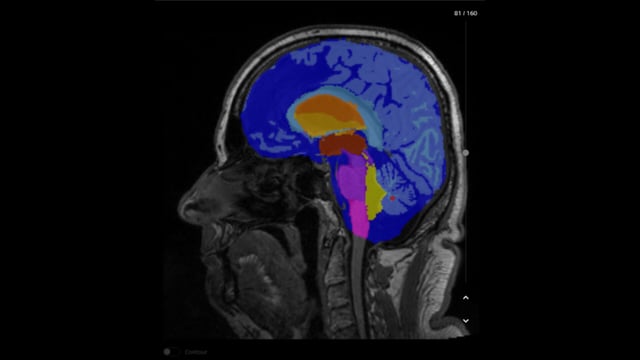 MRI Interpretation Assistants Cleared By FDA