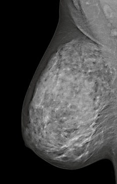 Breast Density Notification Laws Increase in Legislation