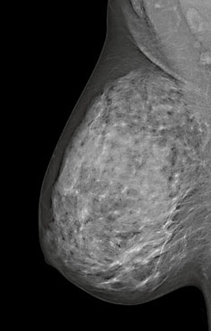 Featured image for Breast Density Notification Laws Increase in Legislation