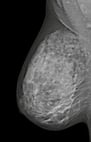 breast-cancer-mammography-032988-edited.jpg