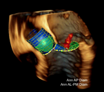 True volume 3D TEE offers clinically relevant volume sizes and rates with volume color Doppler