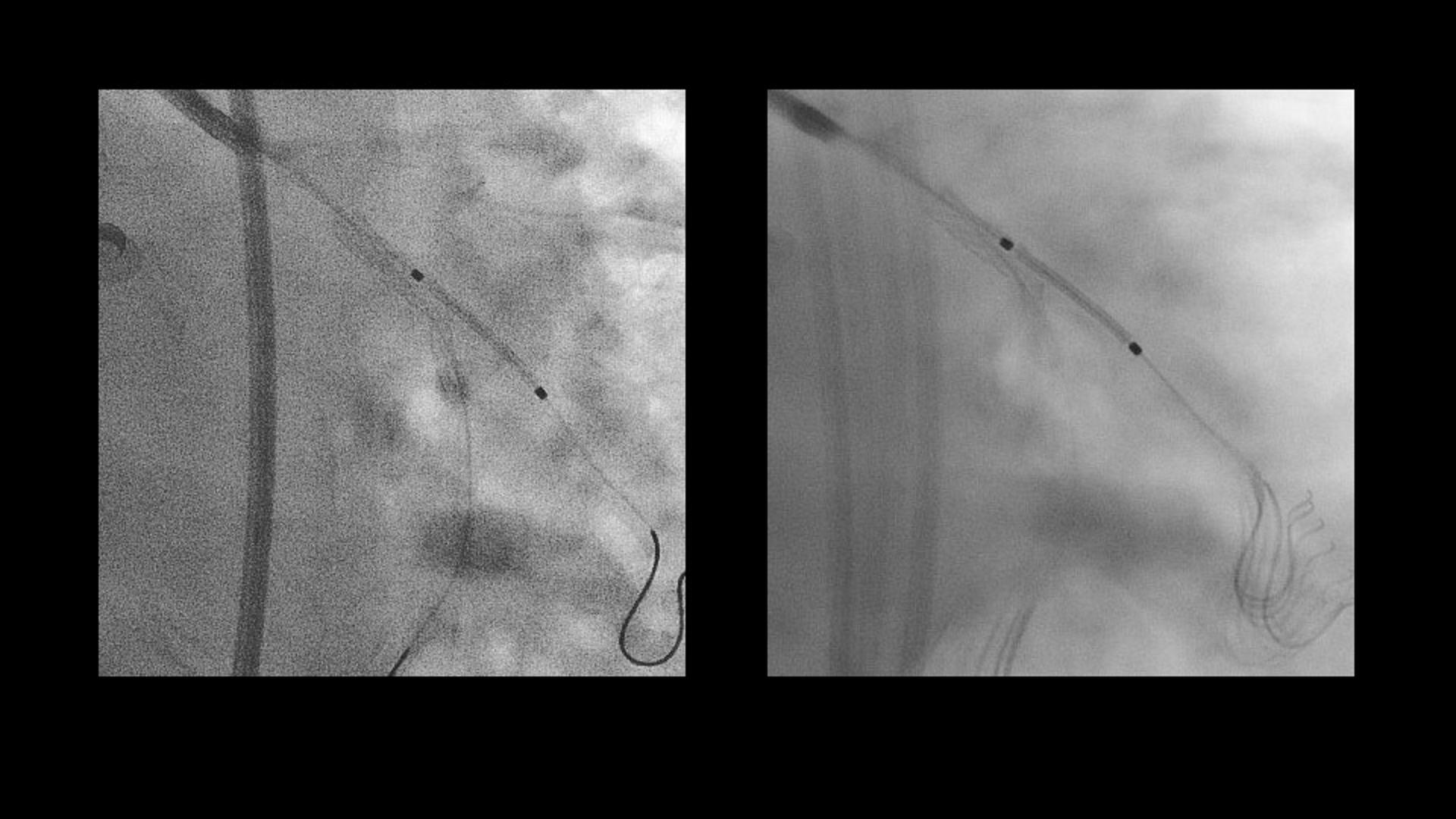 artis-one-features-clearstent-live-1920x1080-rendered_1800000006866700