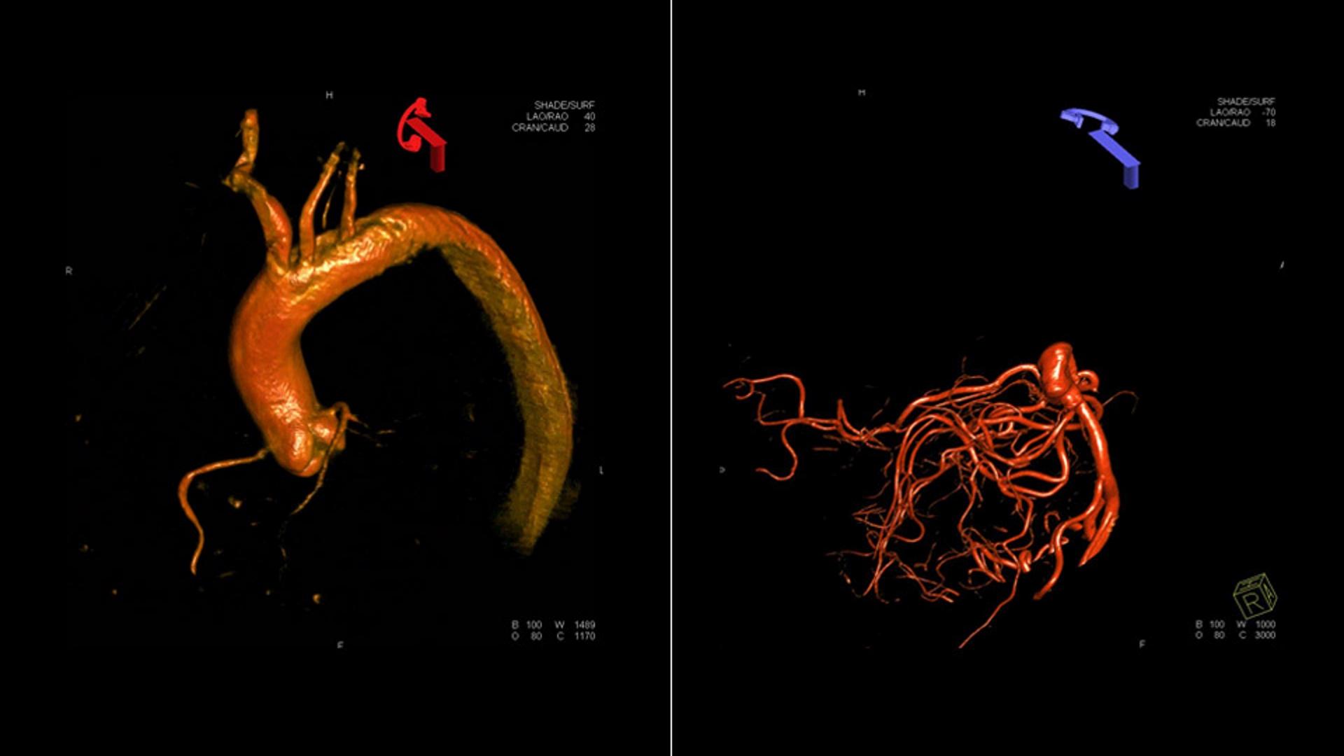 artis-one-features-dynact-cardiac-3d-1920x1080-rendered_1800000006866699