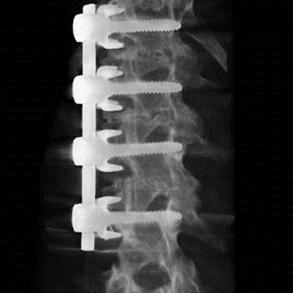spinal-fusion-resized_1800000004136129