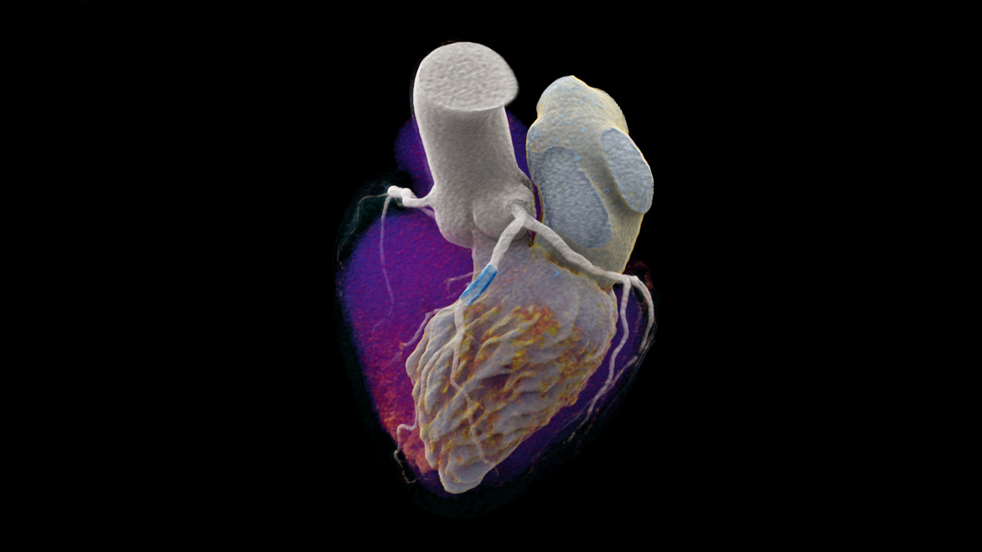 siemens-healthineers-ct-naeotom-alpha-high-res-cardiac