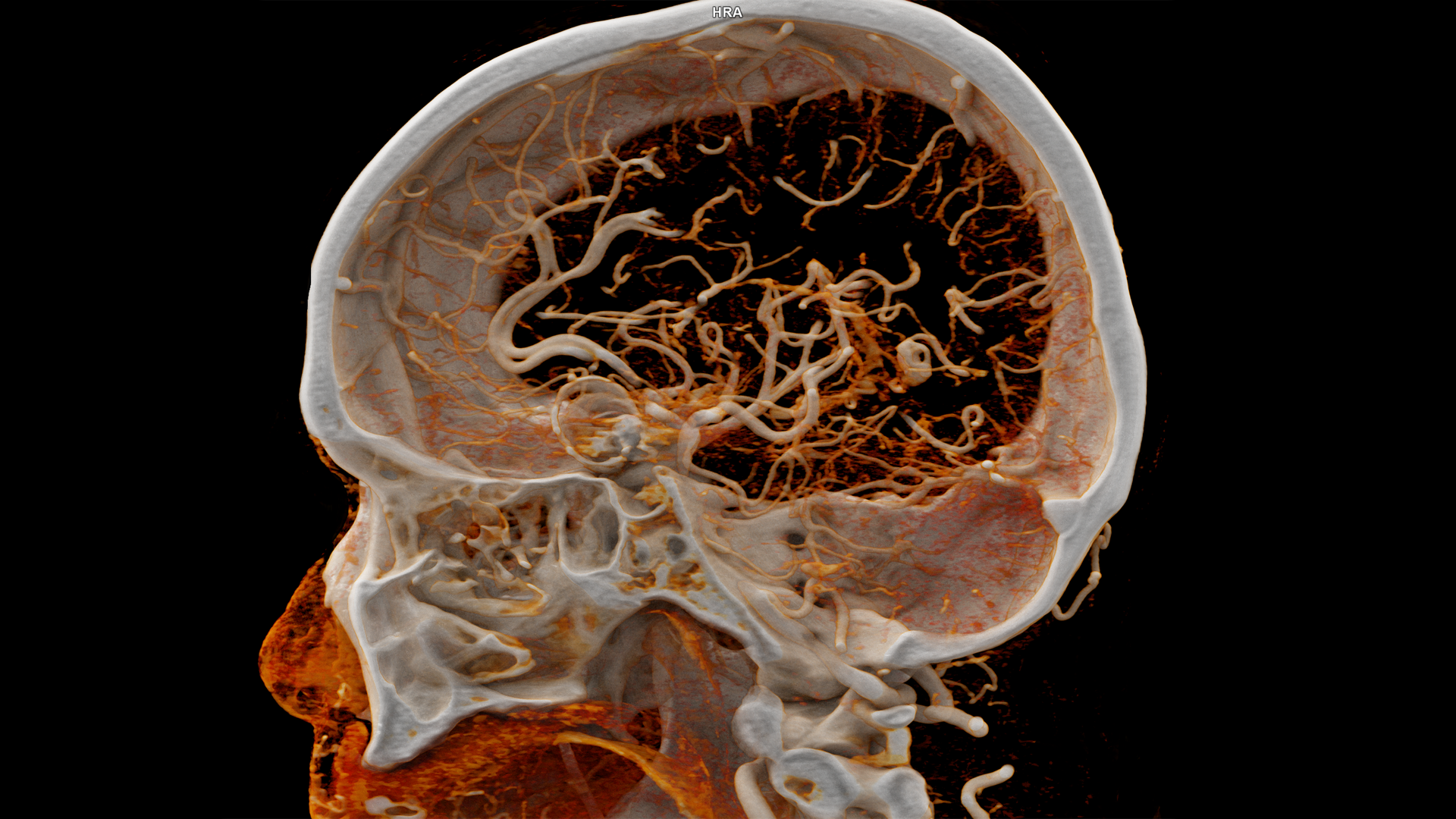 siemens-healthineers-ct-naeotom-alpha-improved-image-contrast