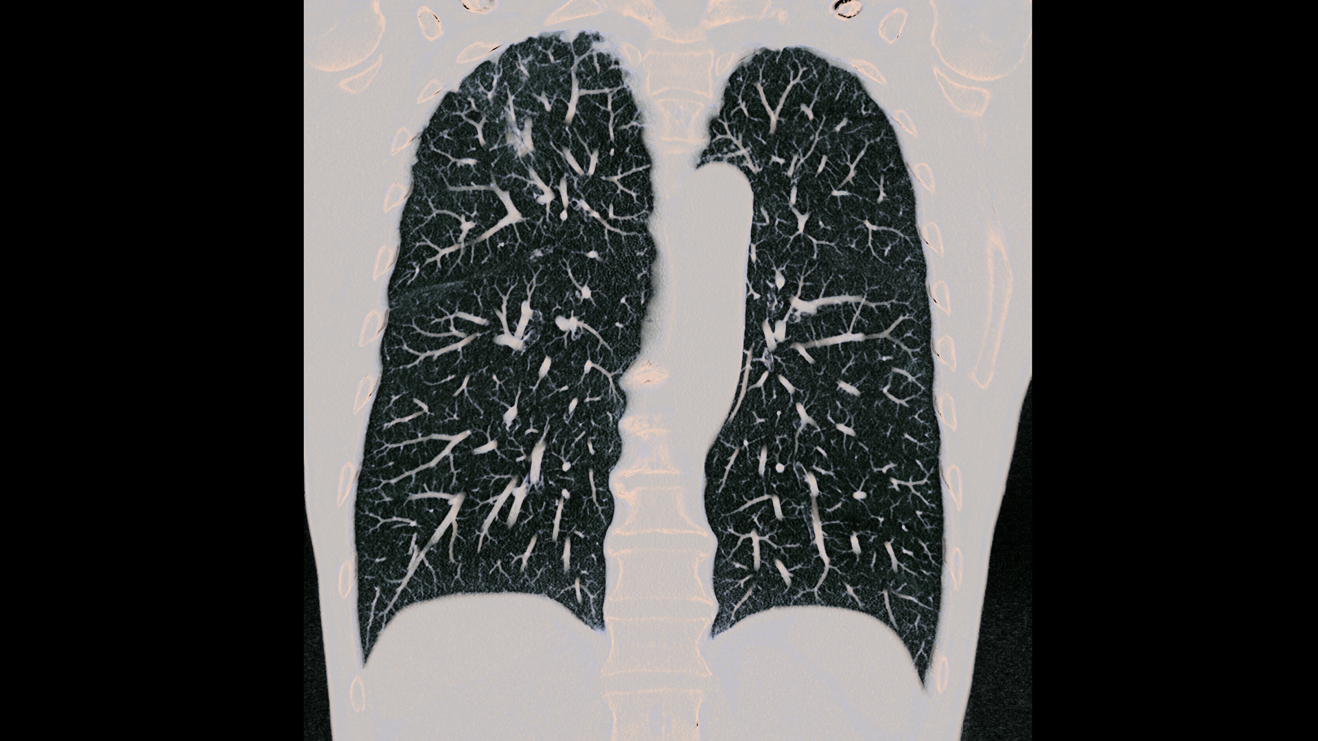 siemens-healthineers-ct-naeotom-alpha-pulmonology_01
