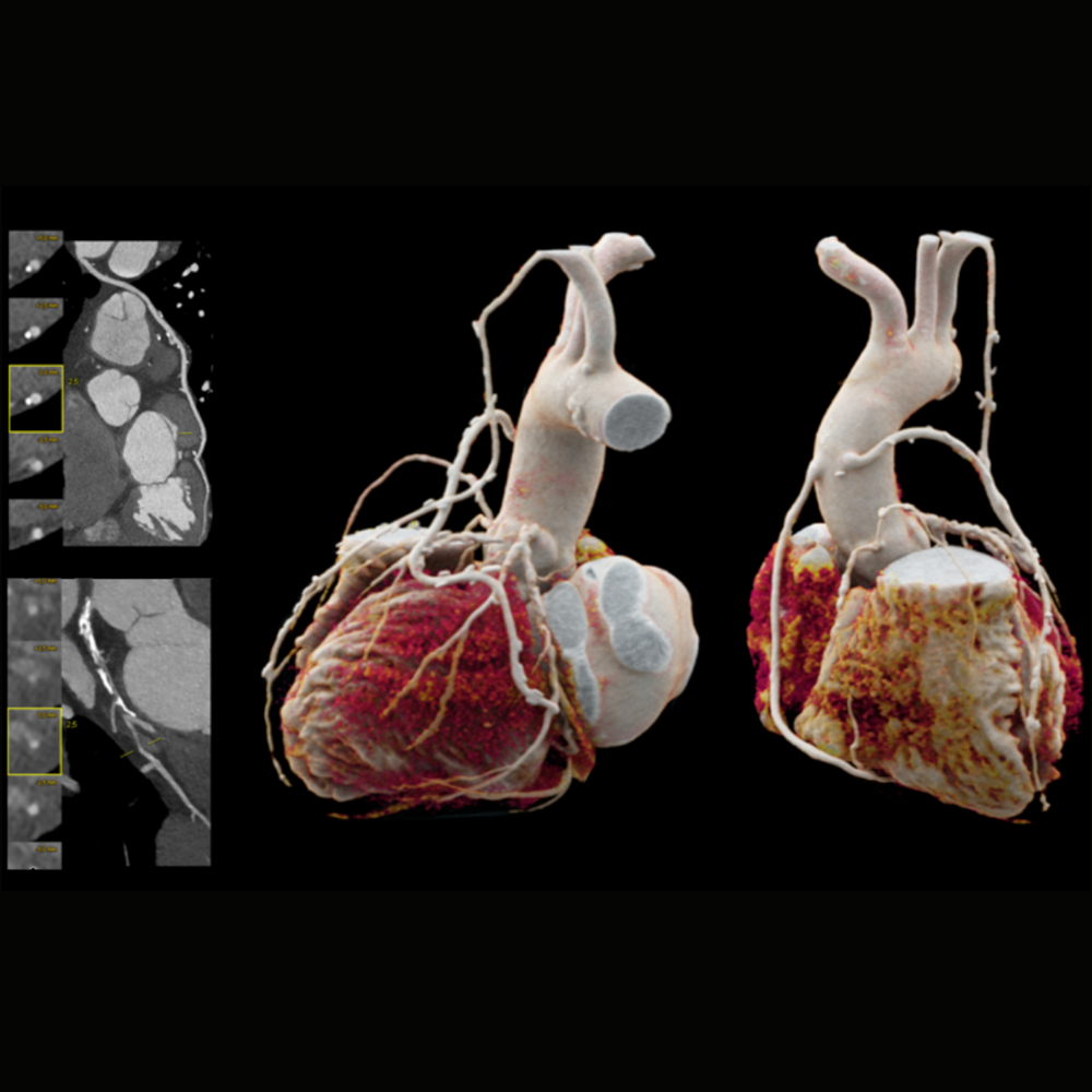 siemens-healthineers-ct-somatom-xcite-coronary-heart-disease