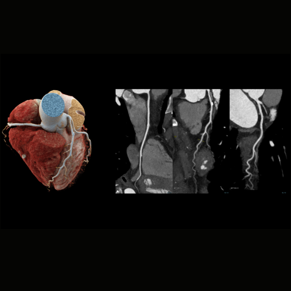 siemens-healthineers-ct-somatom-xcite-low-dose-coronary-scan