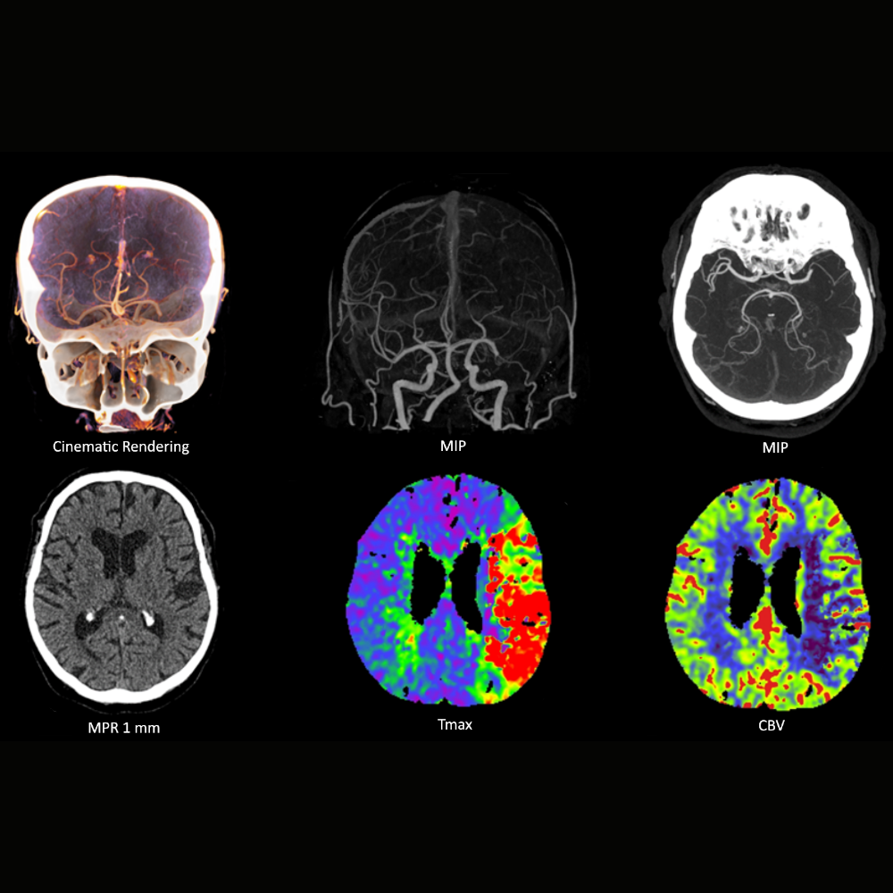 siemens-healthineers-ct-somatom-xcite-stroke-assessment