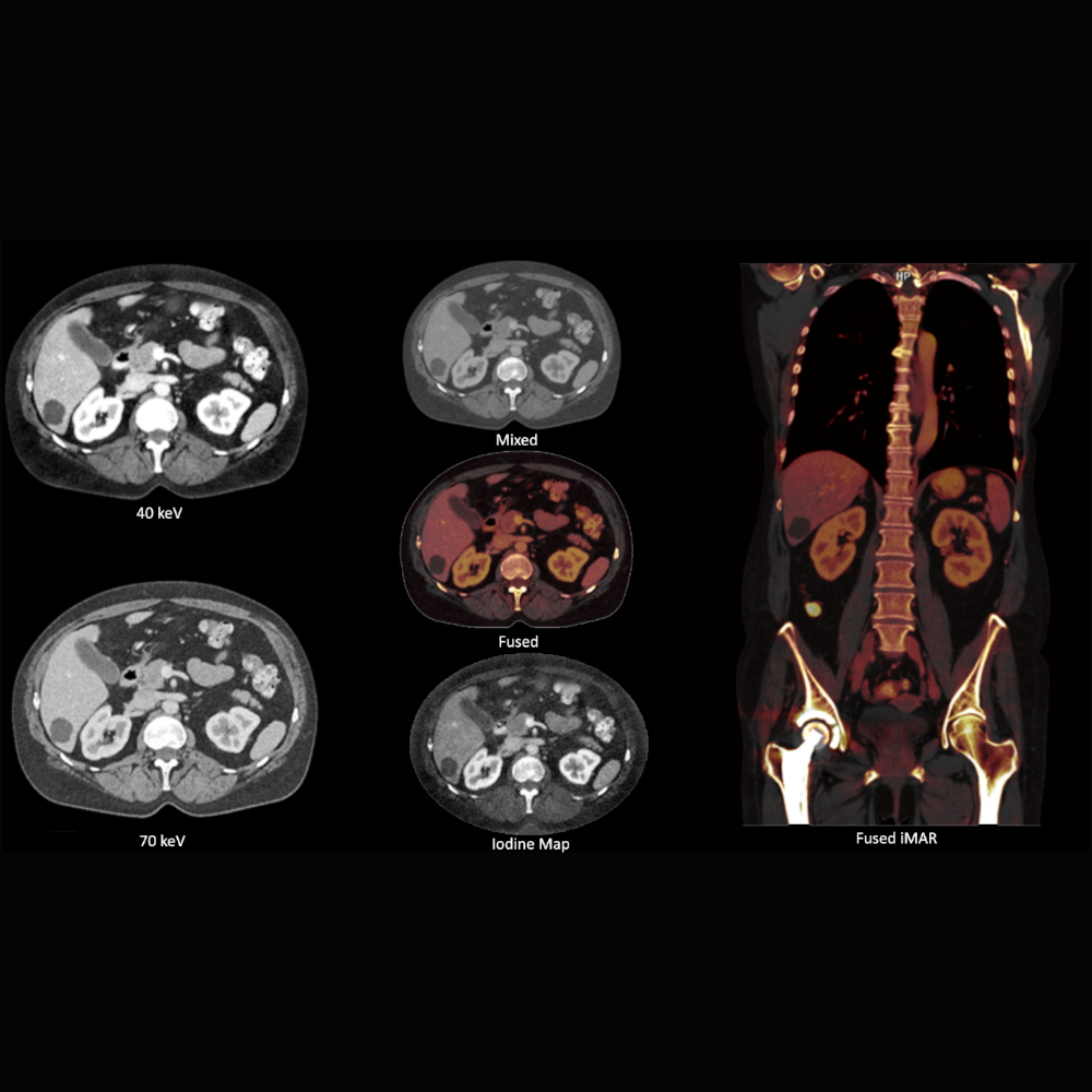siemens-healthineers-ct-somatom-xcite-thorax-pelvis