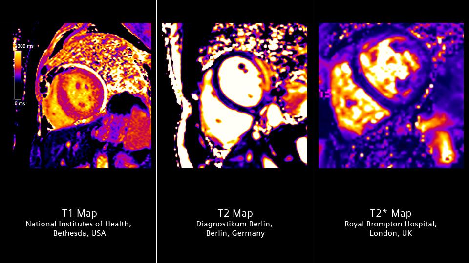 Siemens_Healthineers_MRI_1-5t-MRI-Scanners_MAGNETOM-Sola-Cardiovascular_MyoMaps_16-9_1800000005560048