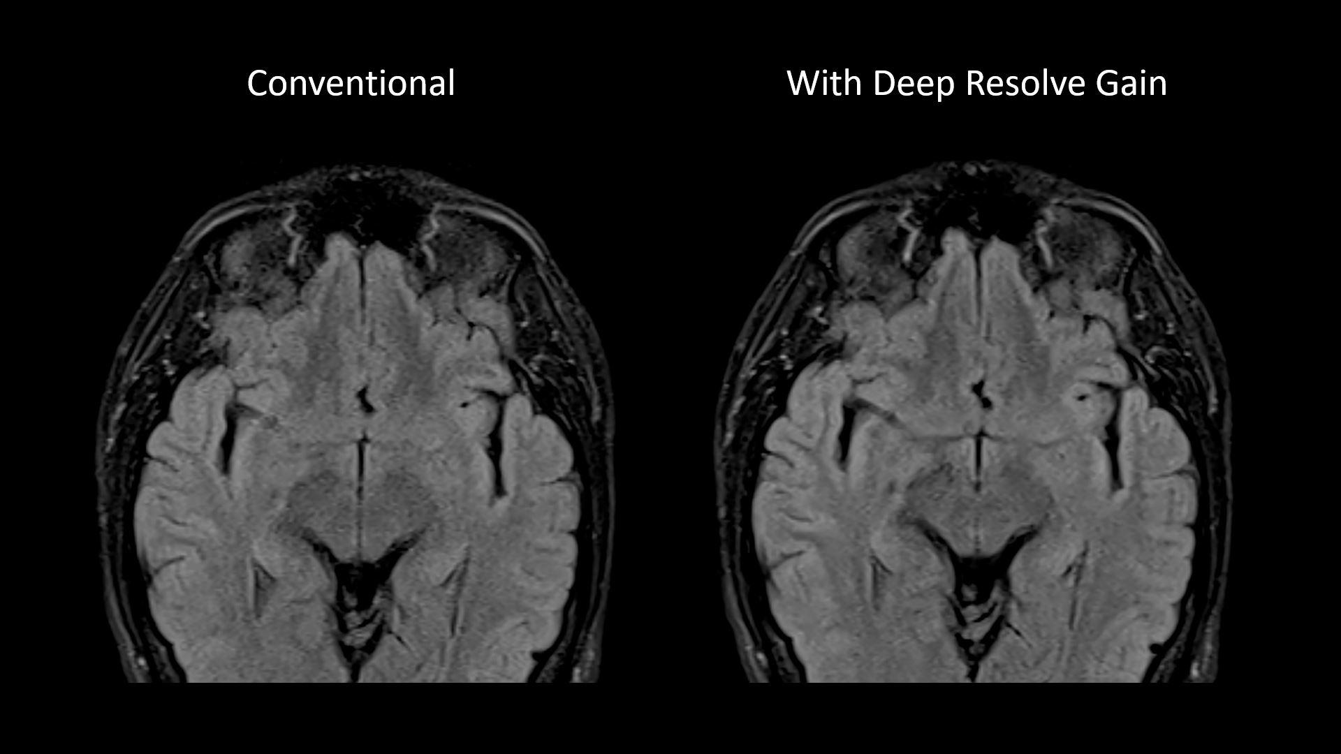 Deep-Resolve-Gain