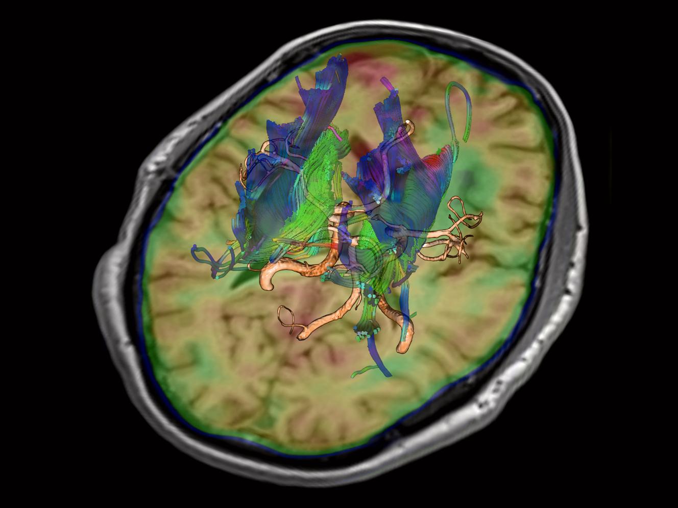 MRI-Biograph-mMR-Clinical-_Neurology_Imaging_1800000000082687