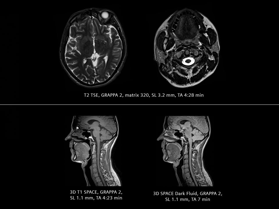 Siemens_MRI_Therapy_MAGNETOM-RT-Pro-edition_Image_head-neck_1800000001939084