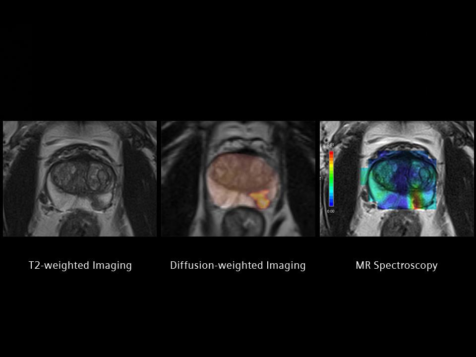 Siemens_MRI_Therapy_MAGNETOM-RT-Pro-edition_Image_prostate_1800000001937792