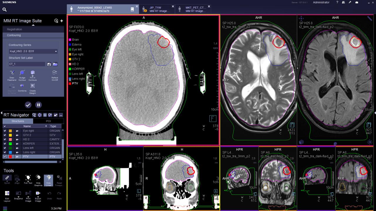 Siemens_MRI_Therapy_MAGNETOM-RT-Pro-edition_Image_syngo-via-rt-image-suite_1800000001937687