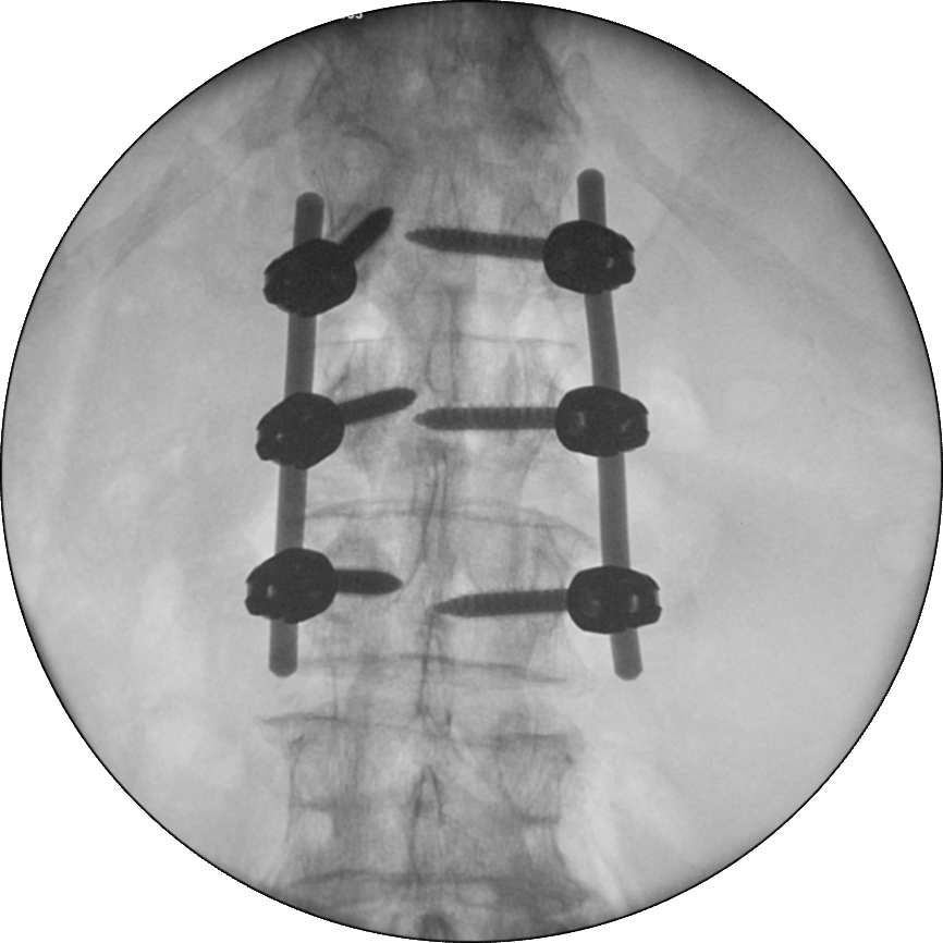 Cios-Select---Spine---With-edge-enhancement