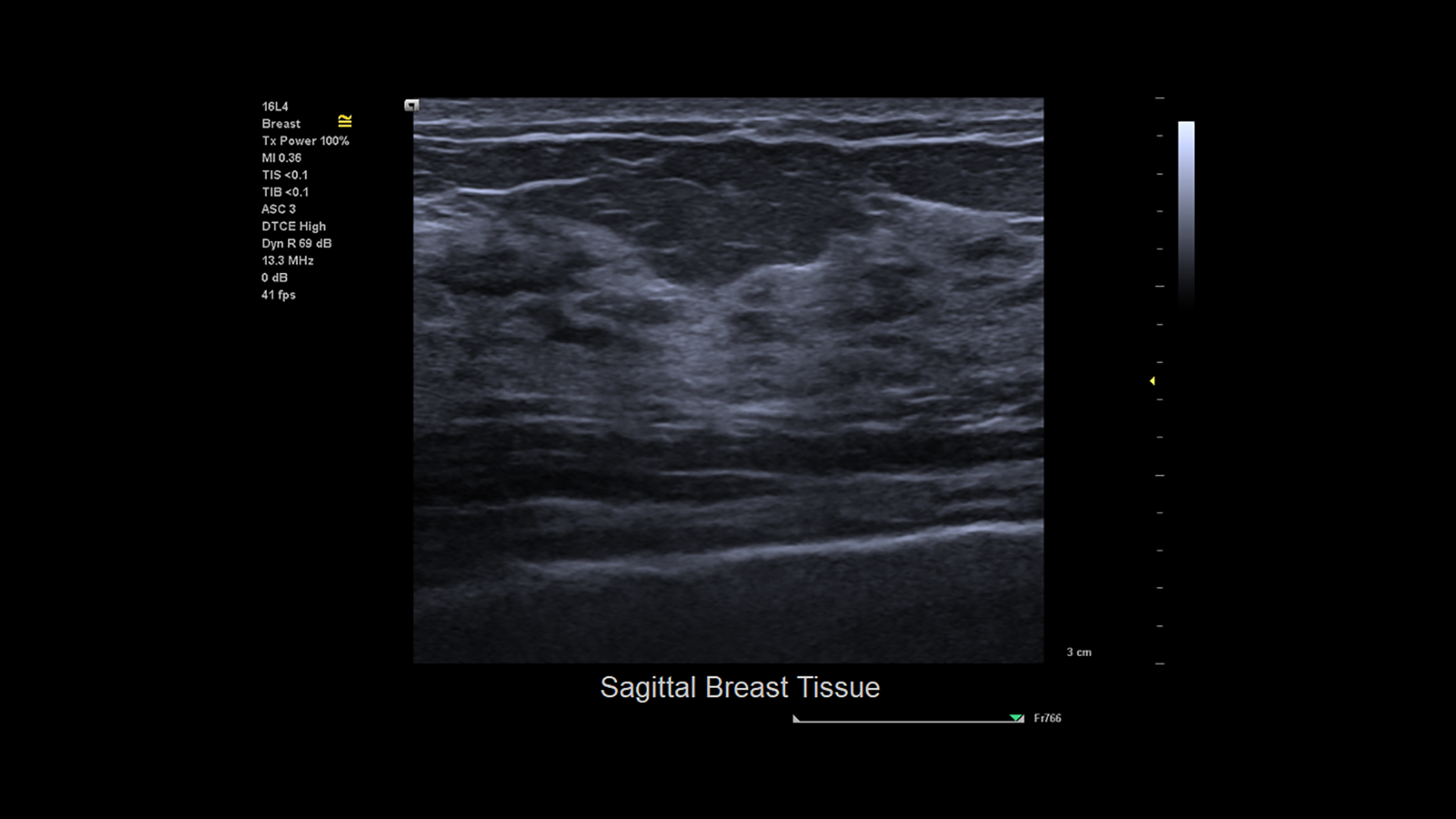 3-SagBreast-HOOD05162003001300