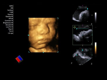 Fetal face in an ultrasound