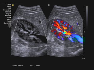 Renal_vascular_demonstrated_using_Clarify_vascular_enhancement_VE_technology_1800000002478280