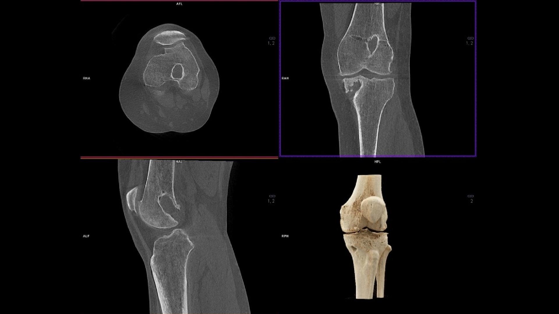 sh-multinom-rax-comprehensive-diagnosis-real-3d-weight-bearing-for-greater-insights