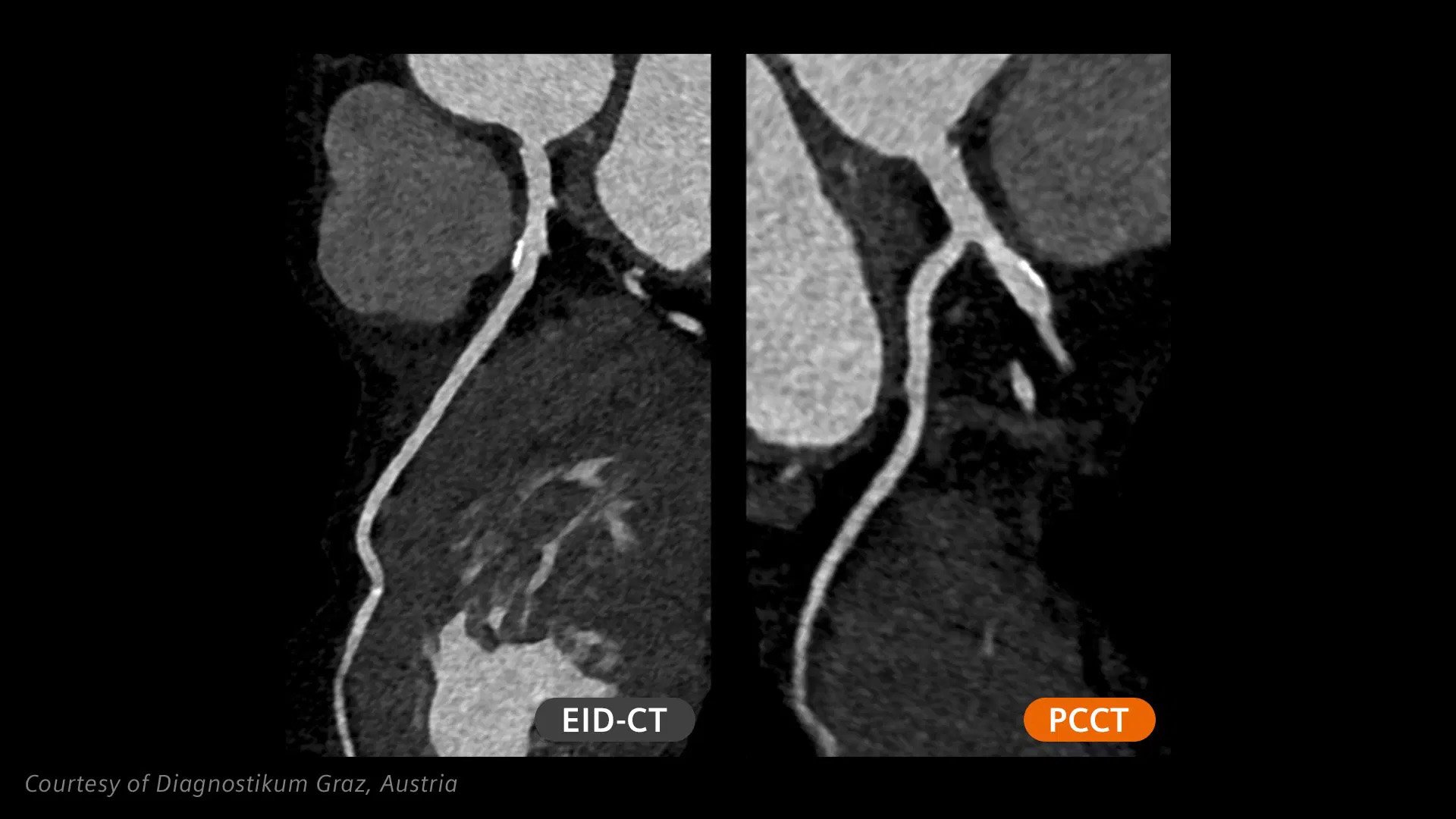 NAEOTOM Alpha.Prime Cardiology
