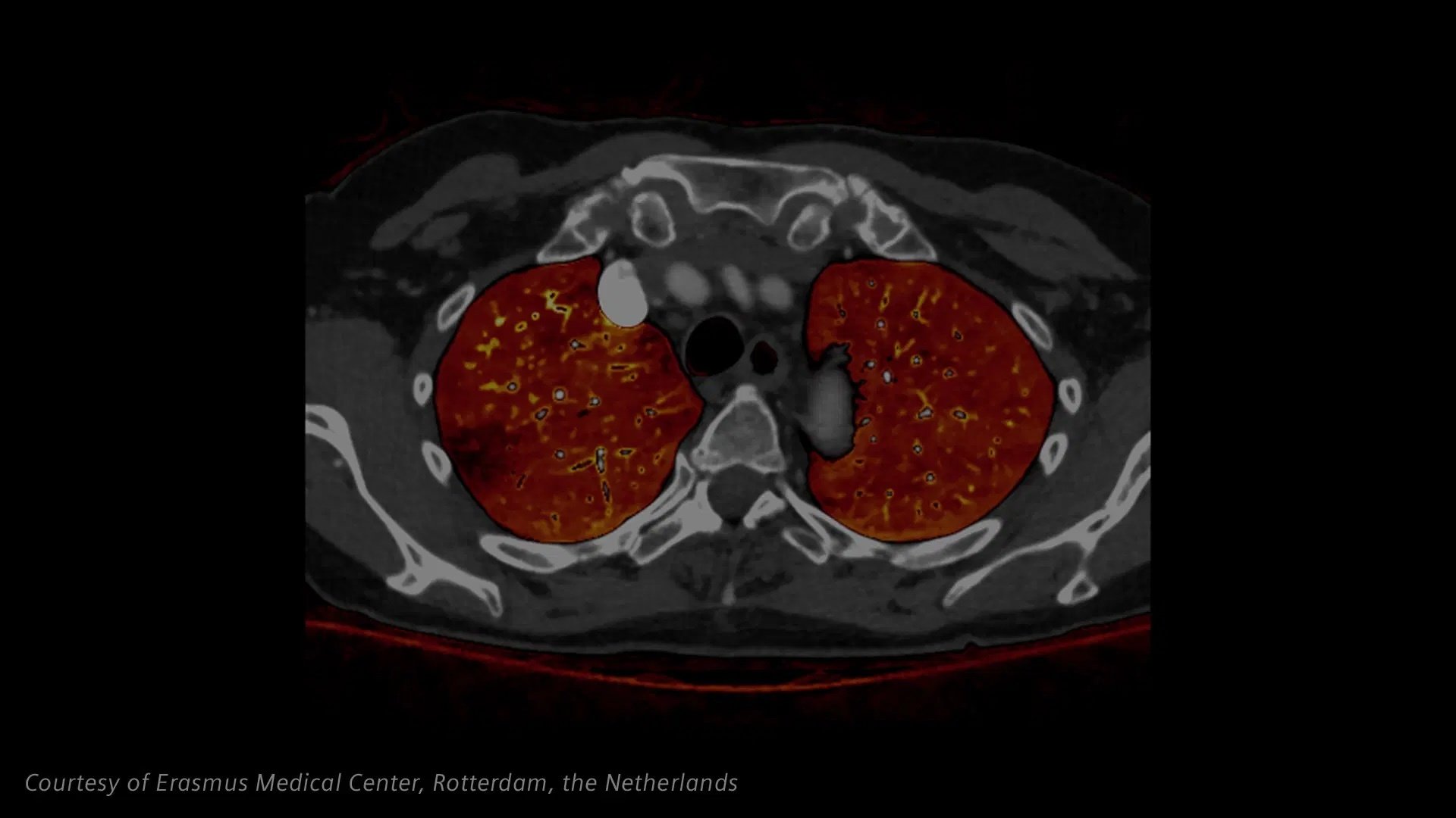NAEOTOM Alpha.Pro High Precision Image