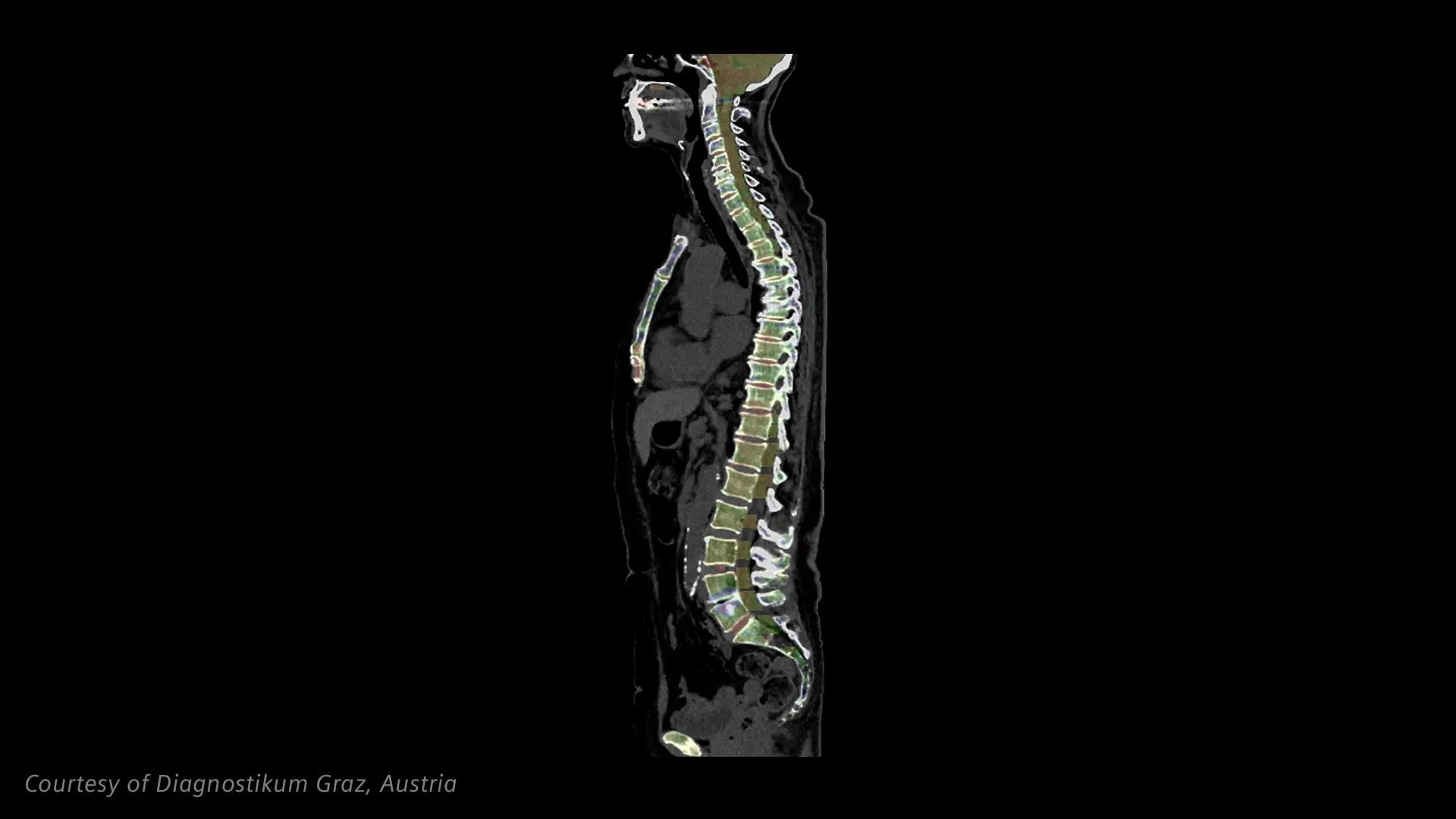 NAEOTOM Alpha.Pro Quantum Spectral Imaging