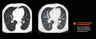 routine oncology-lung