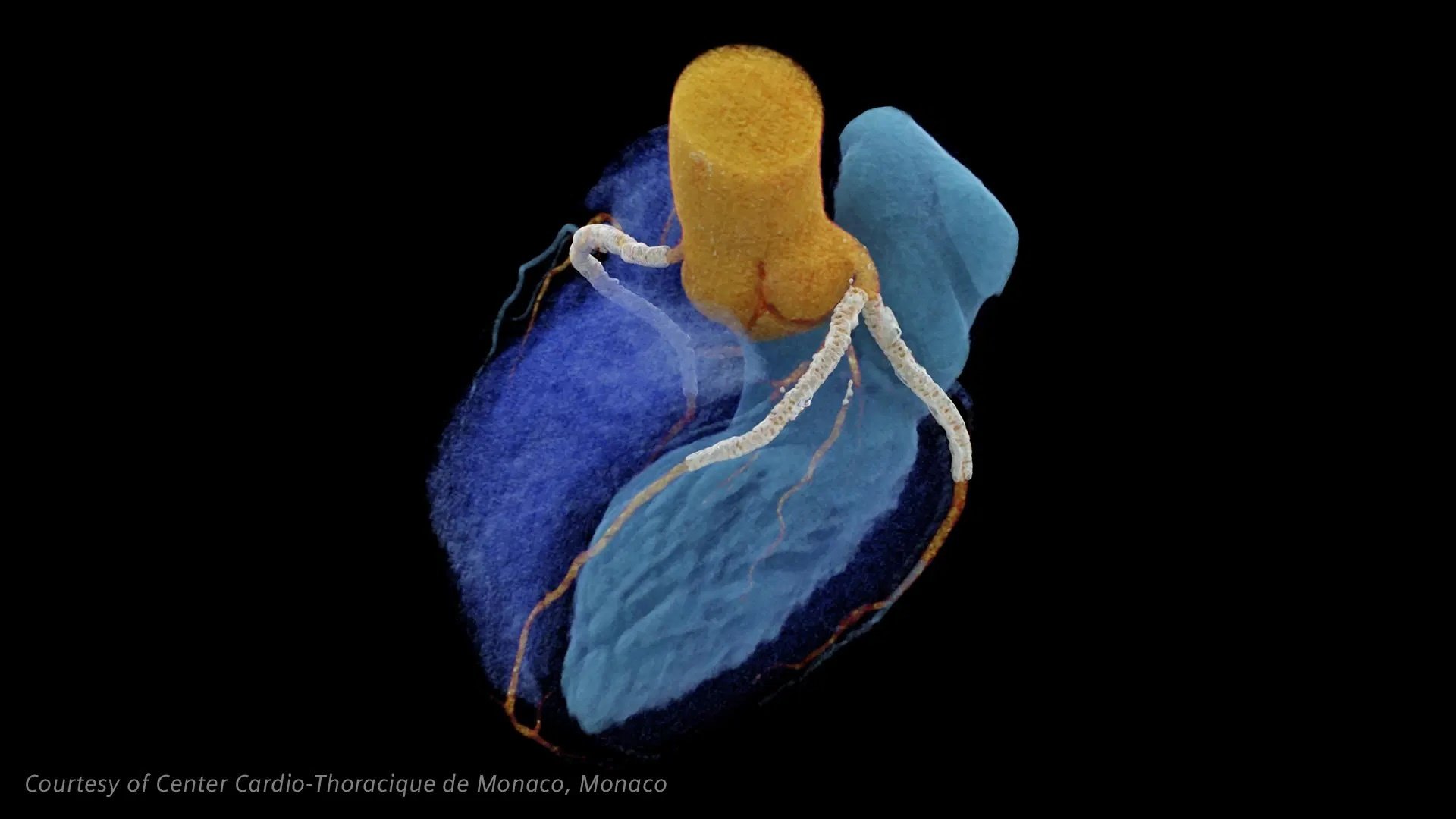 Siemens Healthineers NAEOTOM Alpha Peak Cardiology