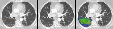 Featured image for Siemens Healthineers announces FDA 510(k) clearance of NAEOTOM Alpha, the world’s first photon-counting CT