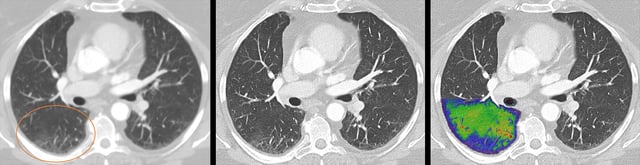Siemens Healthineers announces FDA 510(k) clearance of&nbsp;NAEOTOM&nbsp;Alpha, the world’s first photon-counting CT