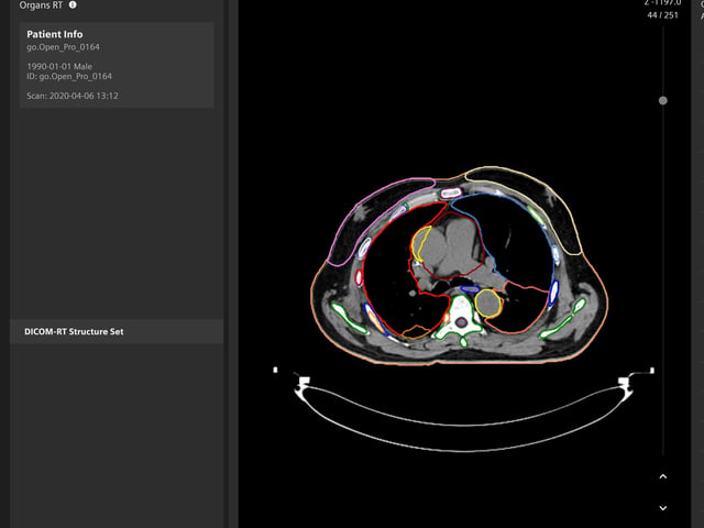AI-Rad Companion Organs RT Intelligent Software Assistant Cleared By FDA