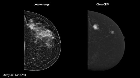 siemens-healthineers-mammography--low-energy-vs-clearcem