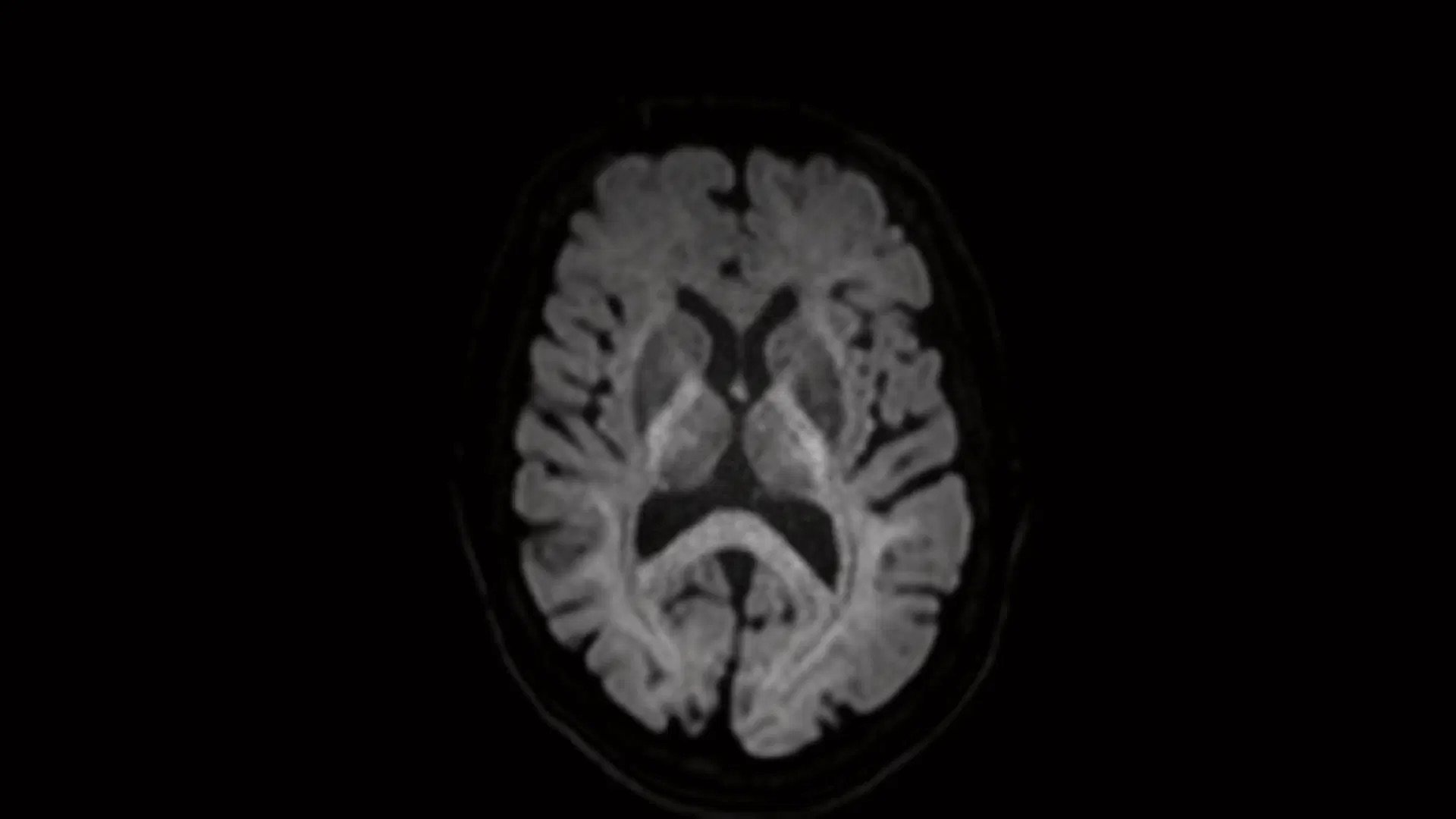 siemens-healthineers_CimaX_Head_DTI_64dir_b3000_p3_s2_DRB_DRS_1920x1080