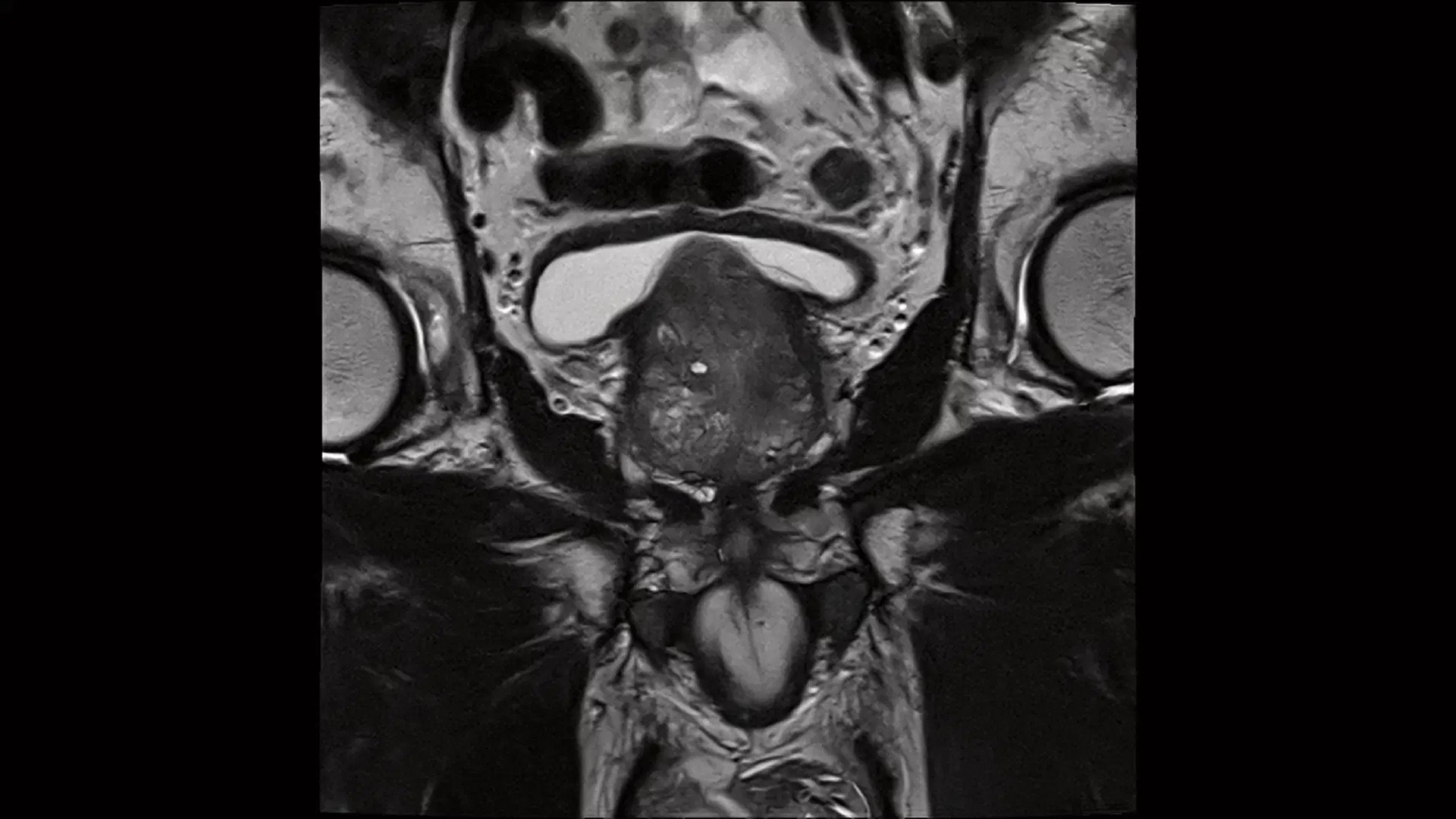 siemens-healthineers_CimaX_Pelvis_male_T2_TSE_cor_DRB_DRS_1920x1080