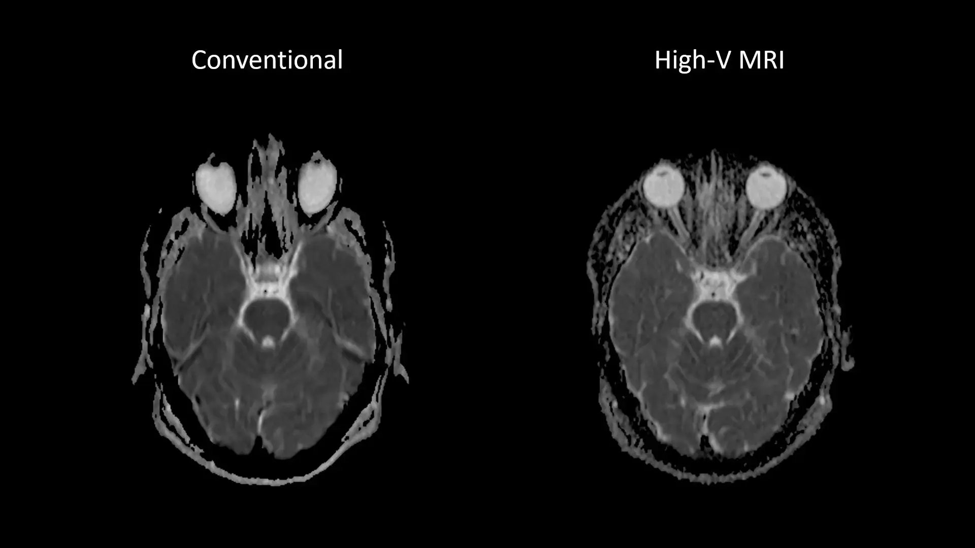 siemens-healthineers_mri-magnetom-free-max_Head