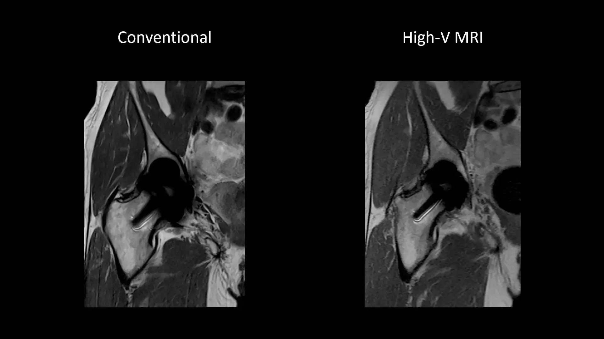 siemens-healthineers_mri-magnetom-free-max_Hip