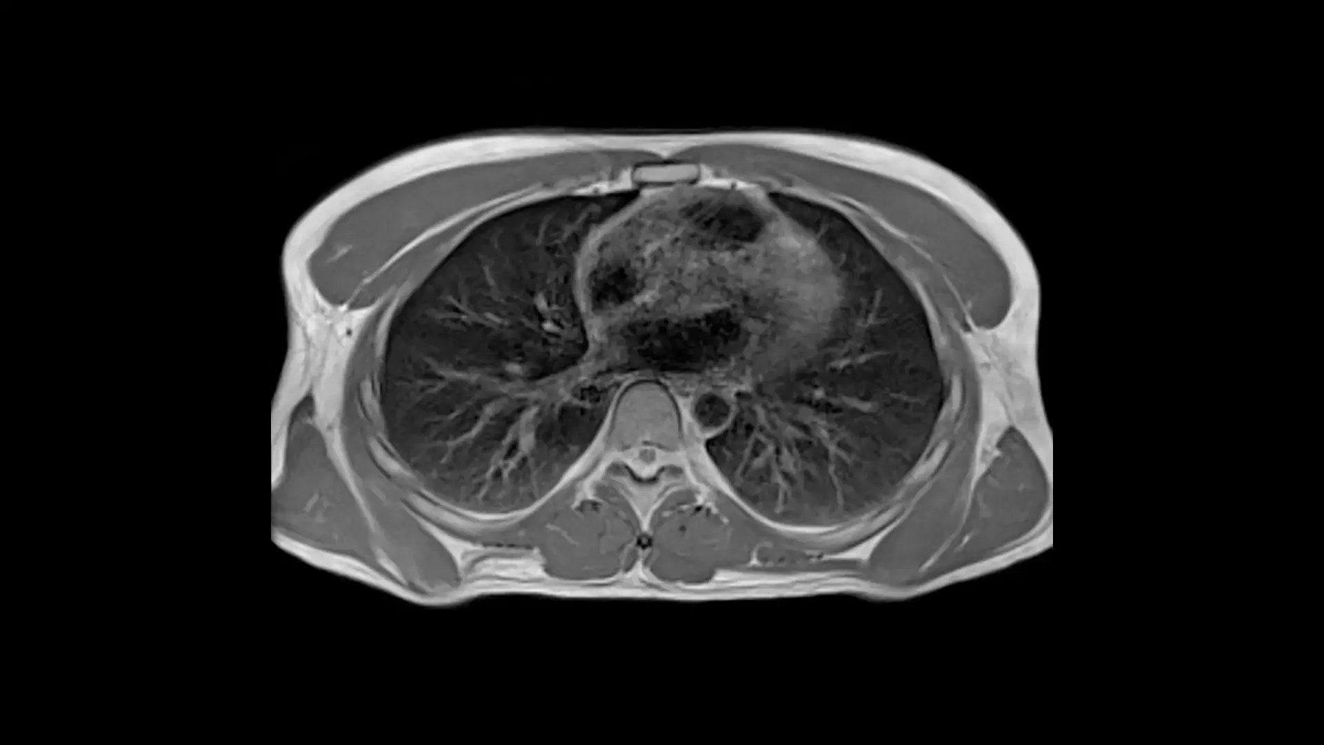 siemens-healthineers_mri-magnetom-free-max_Thorax_fBLADE-16x9