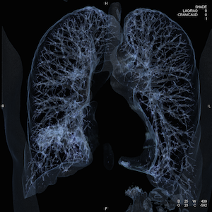 Featured image for Ready, Set, Bill! Imaging Providers Can Now Submit Claims for LDCT Lung Cancer Screenings