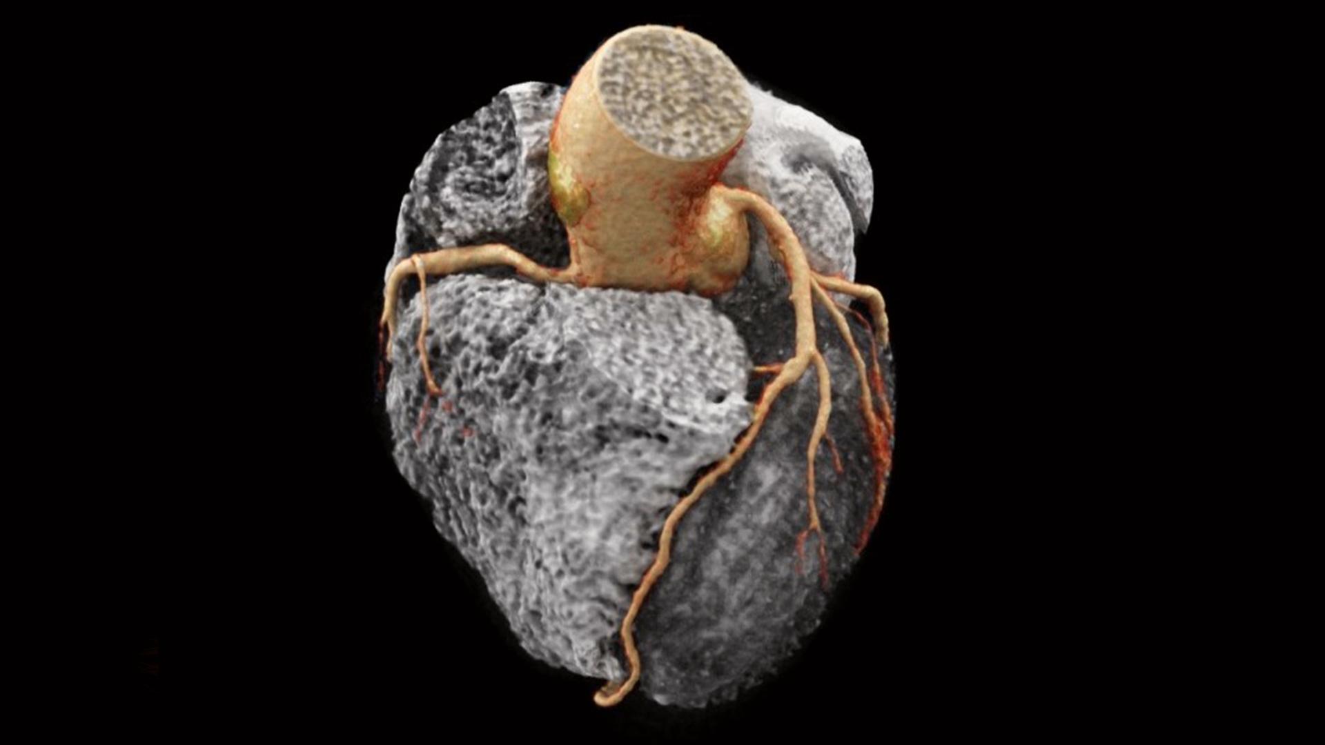 CT-scan-machine_coronary