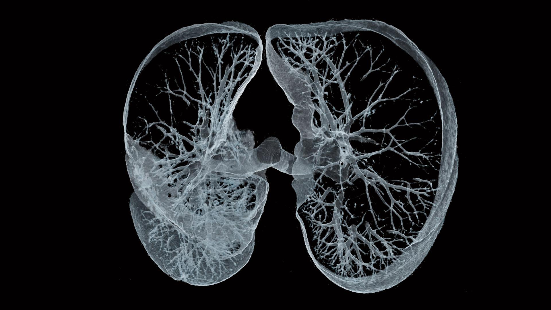 CT-scan-machine_lung_structural-changes