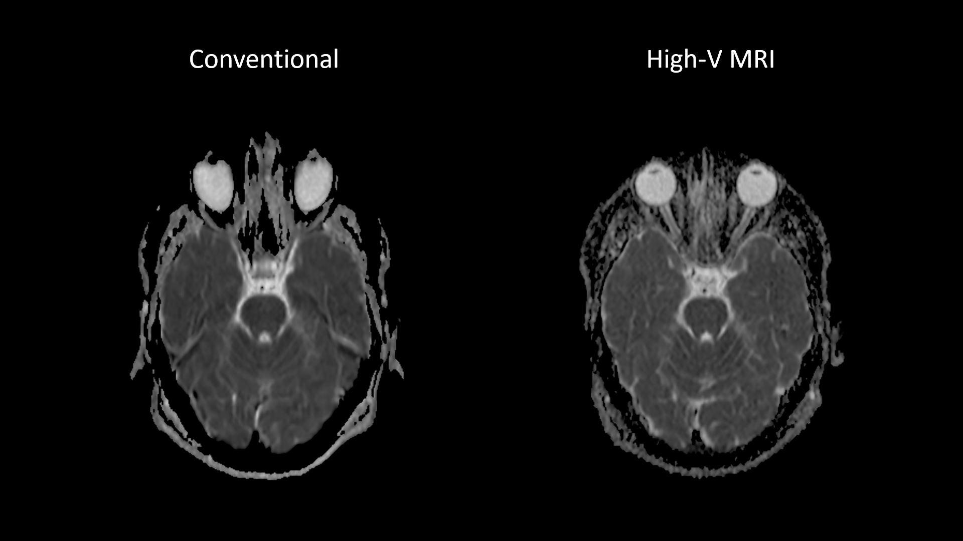 siemens-healthineers_mri-magnetom-free-max_Head