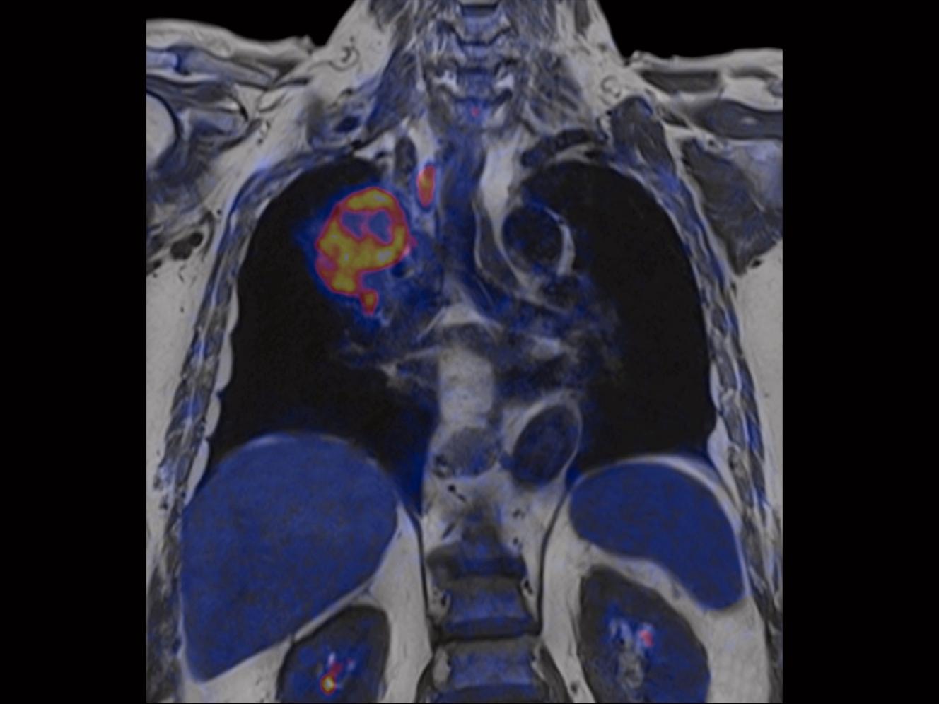 MRI-Biograph-mMR-Clinical-Oncology_Imaging_1800000000082689