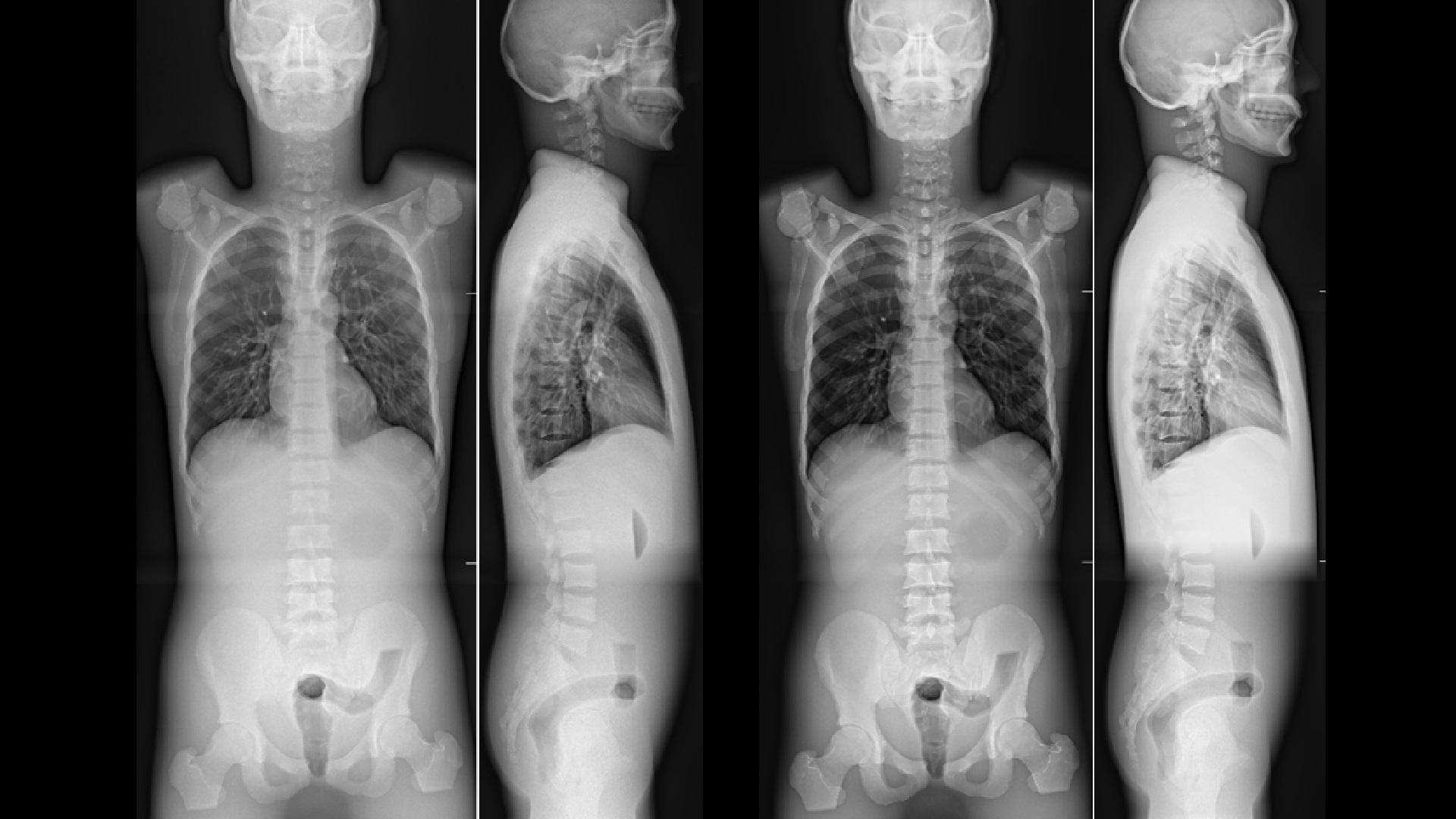 sh-multinom-rax-precise-insights-low-dose-scoliosis